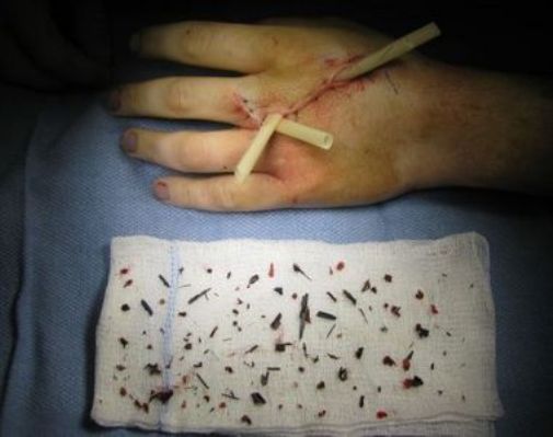 dudes hand after arrow explosion